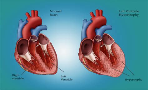 signs of left ventricular hypertrophy